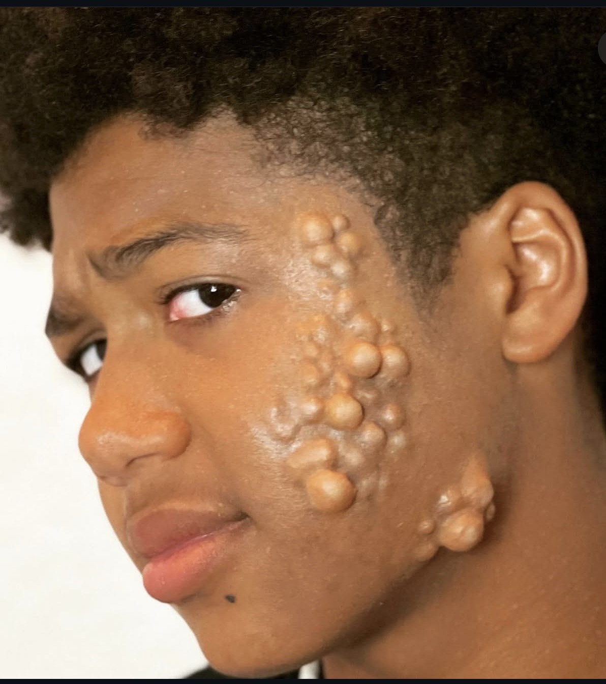 Silicone Boils prosthetic applied and painted