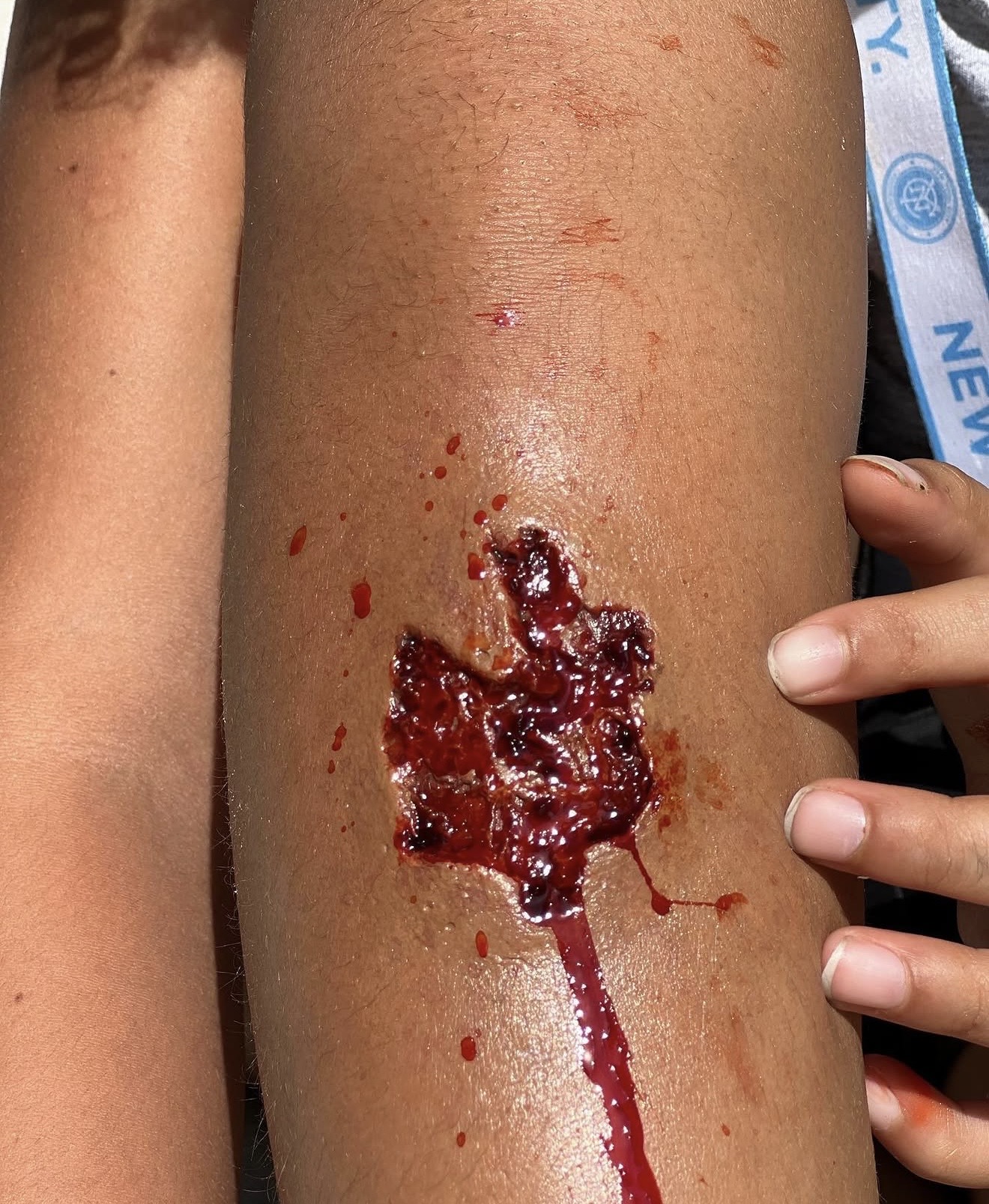 Small Gash prosthetic transfer applied and bleeding