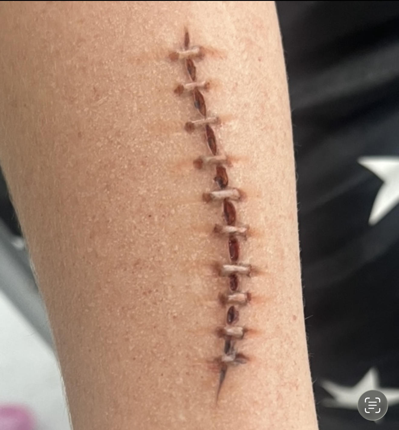 Wound with Stitches prosthetic applied and painted