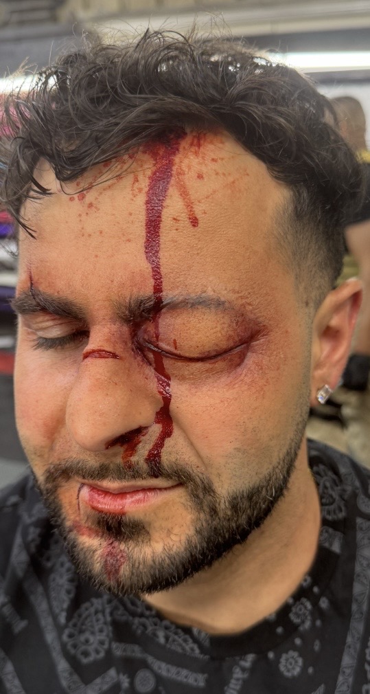 Swollen Left Eye Closed prosthetic applied and painted